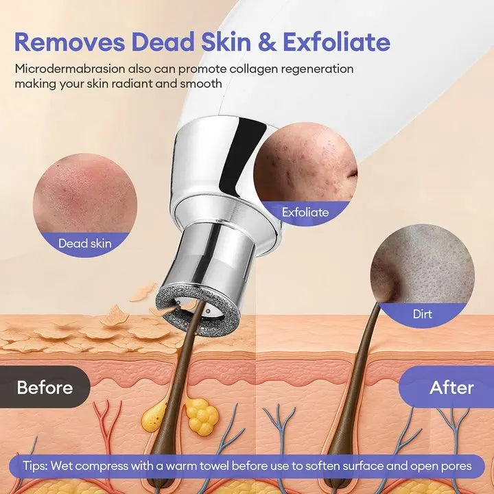 Diamond Microdermabrasion Resurfacing System